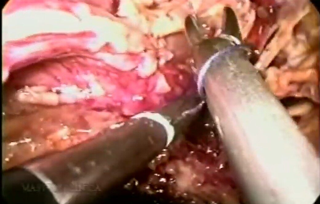 Fístula intestinal - correção laparoscópica - Master Clínica