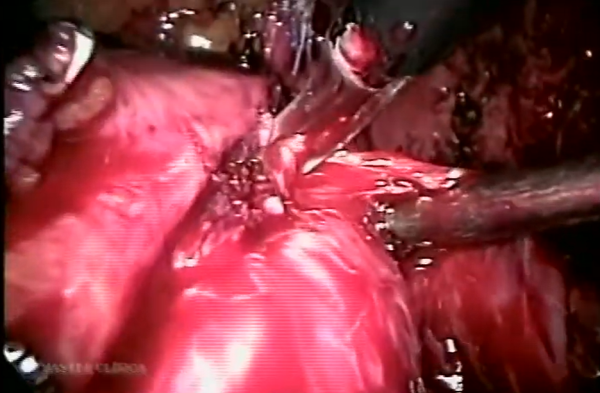Prostatectomia radical laparoscópica - Master Clínica
