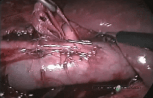 Ureter retrocava - correção laparoscópica