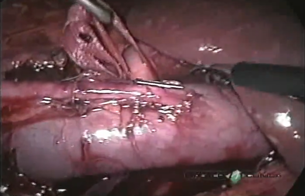 Ureter retrocava - correção laparoscópica