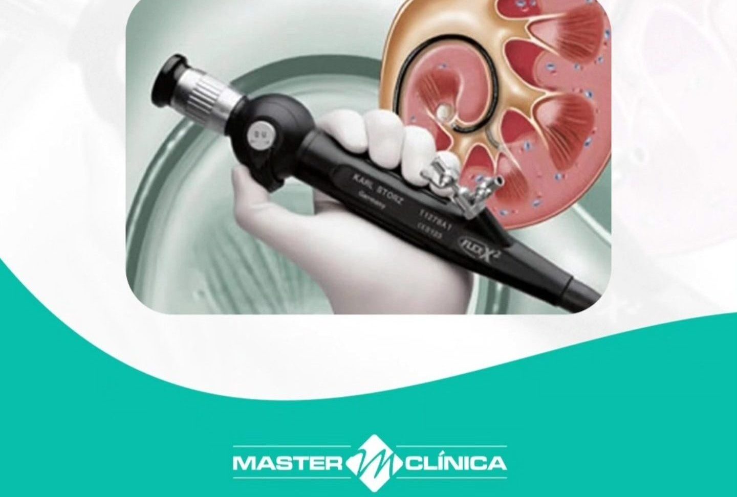 Pioneirismo em litíase renal – aquisição do ureteroscópio flexível
