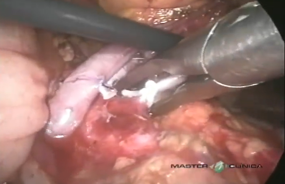 Nefrectomia laparoscópica de doador renal vivo