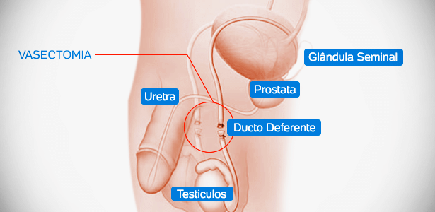 Cirurgia de vasectomia - Master Clínica Cascavel