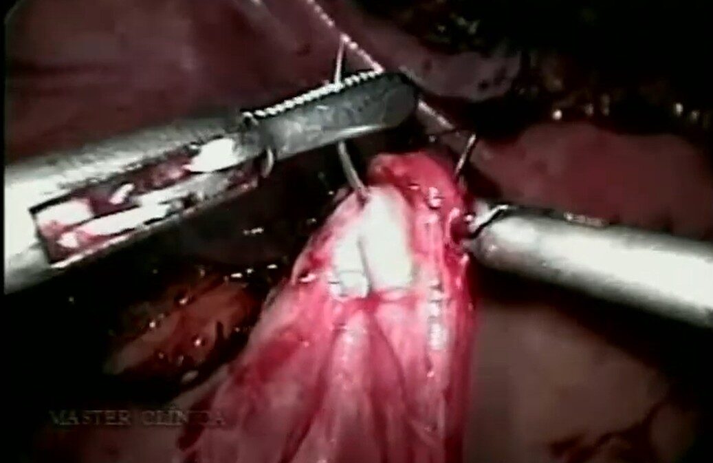 Tuberculose urinária - ileocistoplastia e nefroureterectomia laparoscópica