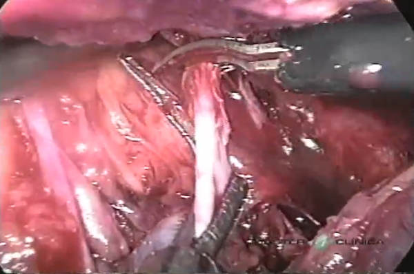 Estenose do ureter distal - Reimplante ureteral laparoscópico