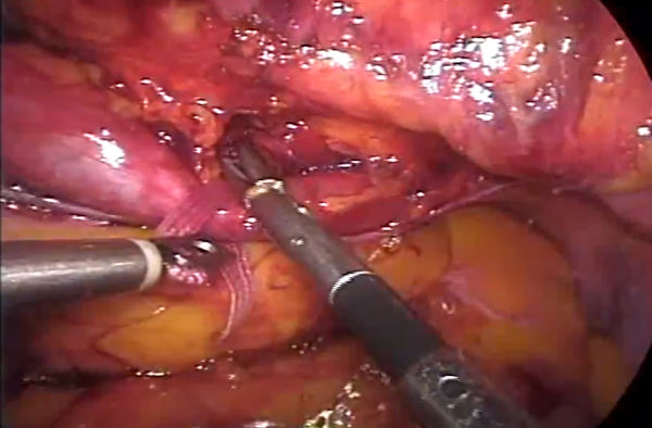 Cálculo em ureter proximal - ureterolitotomia laparoscópica