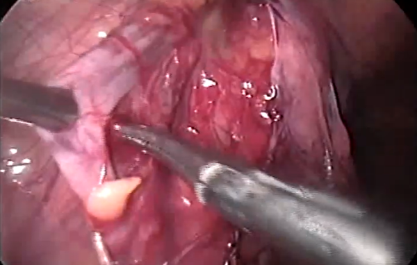 Correção de varicocele por videolaparoscopia